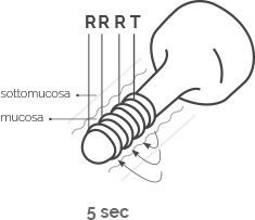 Vaginal Dynamic Radiofrequency